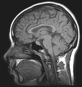 220px-MRI_brain